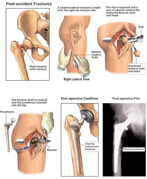 hip-replacement-surgery-steps